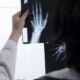 Someone holding up an x-ray scan of someone's hand